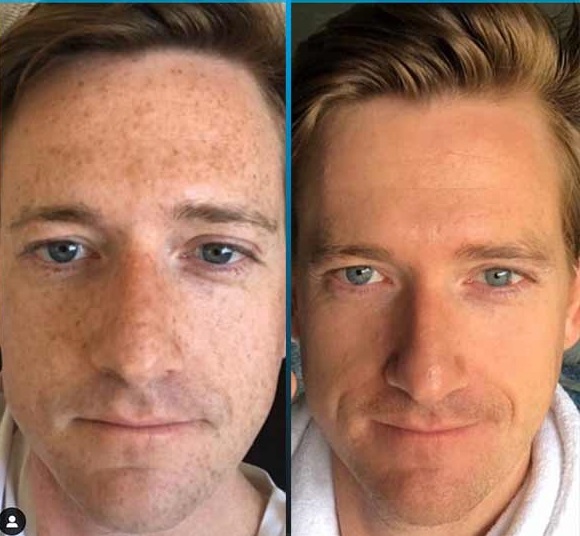 Dark Spots or Uneven Skin Tone?