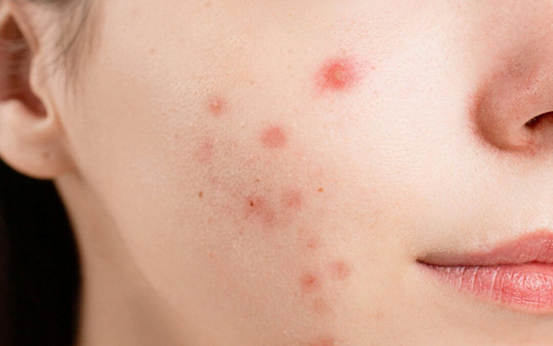 Acne or Pimples?